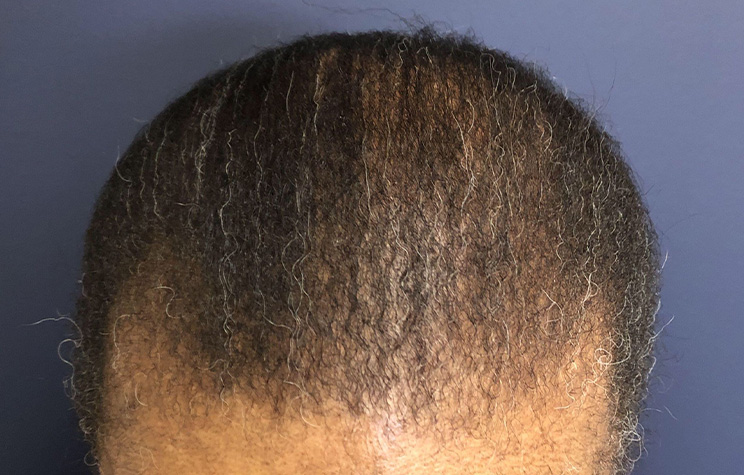 after male hair restoration top view case 1480