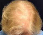 before top view female hair restoration case 1486