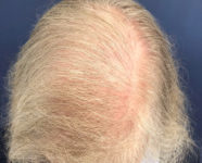 after top view female hair restoration case 1486