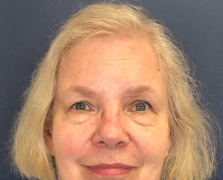 after front view female hair restoration case 1486