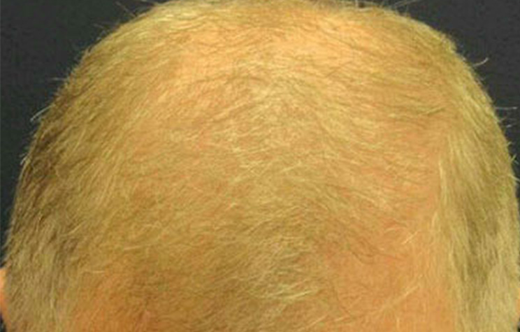 before male hair restoration top view case 1466