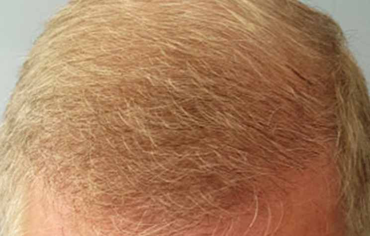 after male hair restoration top view case 1466
