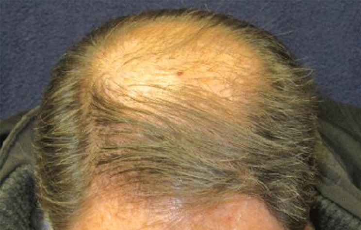 before male hair restoration top view case 1469