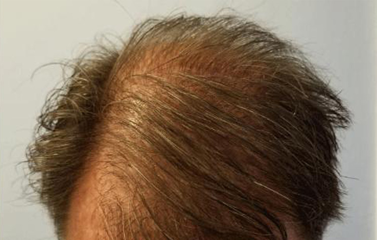 after male hair restoration top view case 1469