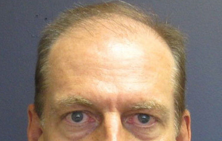 before male hair restoration front view case 1472