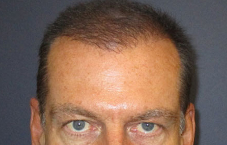after male hair restoration front view case 1472