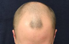 before male hair restoration top view case 1475
