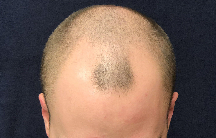before male hair restoration top view case 1475