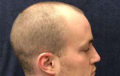before male hair restoration side view case 1475