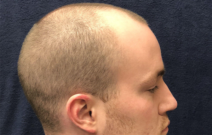before male hair restoration side view case 1475