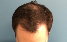 after male hair restoration top view case 1475