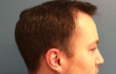 after male hair restoration side view case 1475