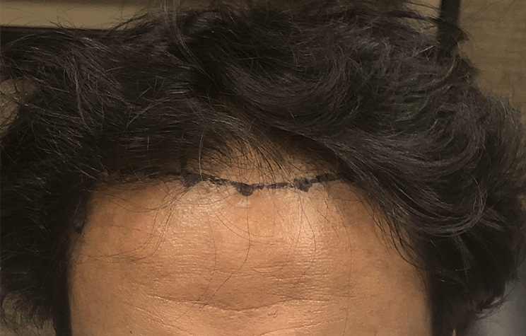 before male hair restoration front view case 1483