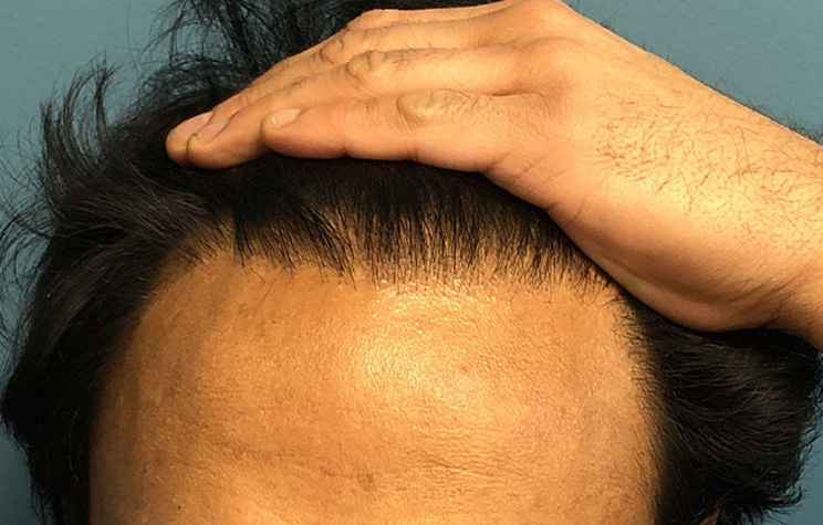 after male hair restoration front view case 1483