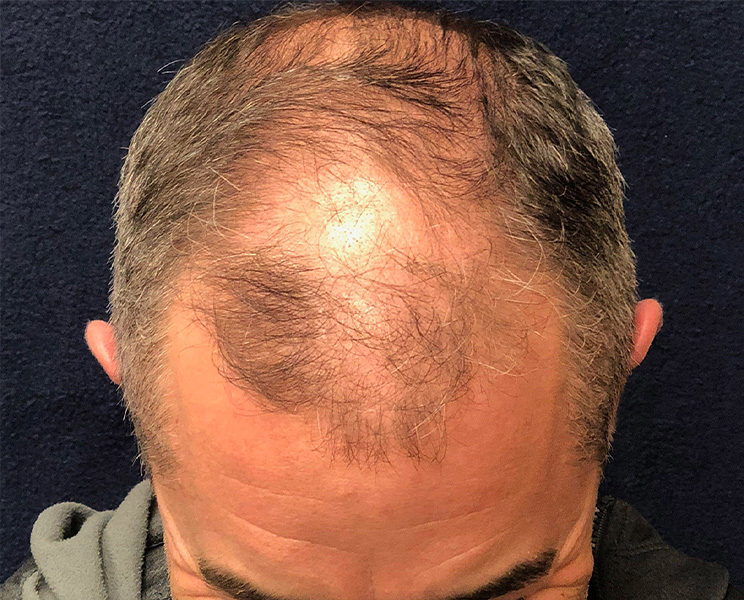 before top view male hair restoration case 1492