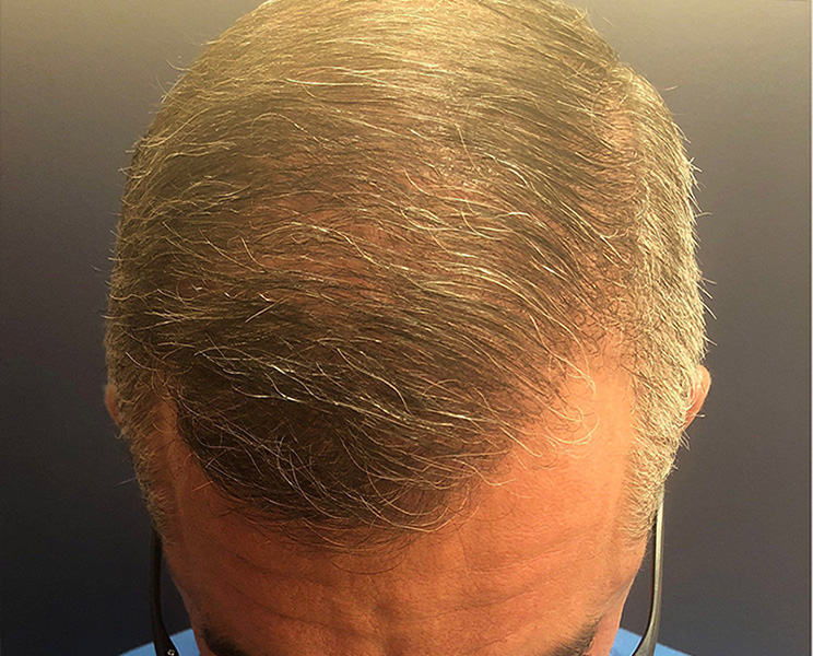 after top view male hair restoration case 1492